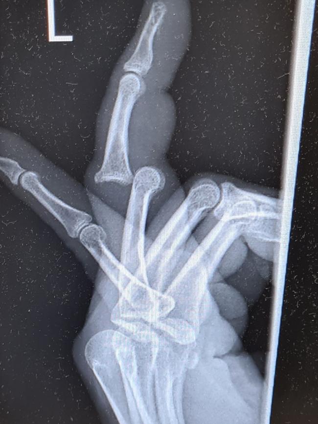 An X-ray of Queensland Labor MP Lance McCallam’s dislocated finger.