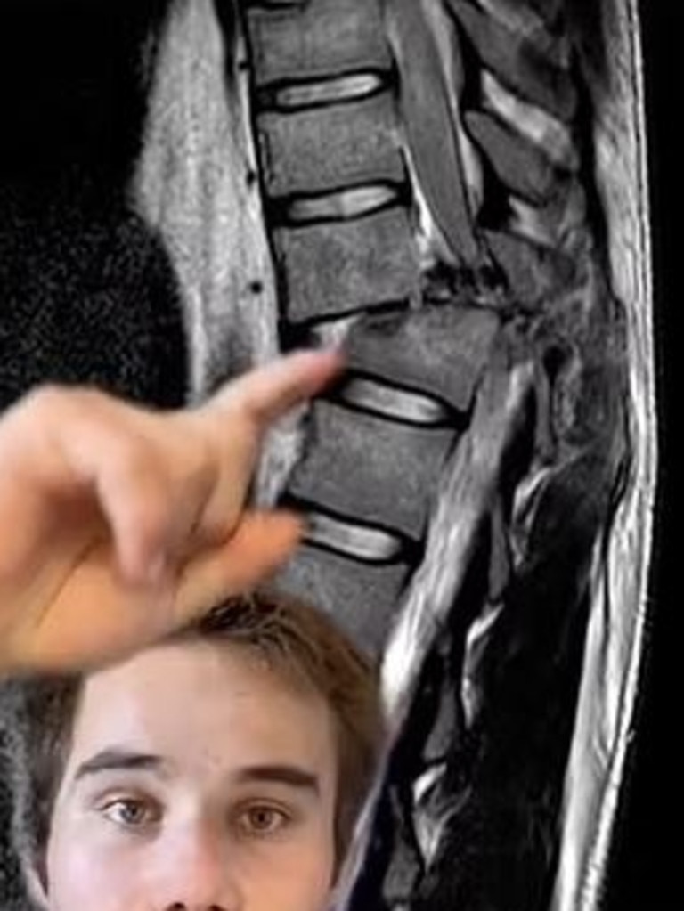 An X-Ray showing the break in Jimmy’s spine. Picture: TikTok/Jimmy Jan