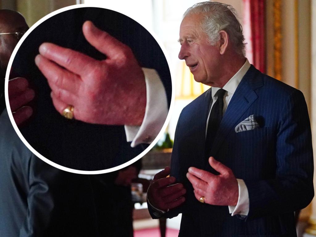 King Charles’ fingers look red and swollen. Picture: Getty Images