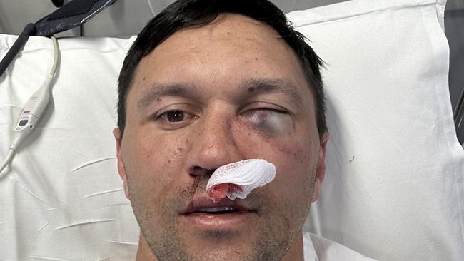 Raiders star Jordan Rapana suffered a fractured cheekbone in his final game for the club. Credit: Supplied.