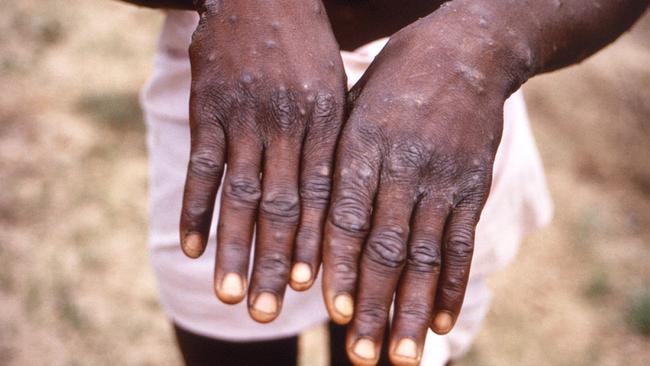 A patient displaying the appearance of the characteristic rash during its recuperative stage of monkeypox.