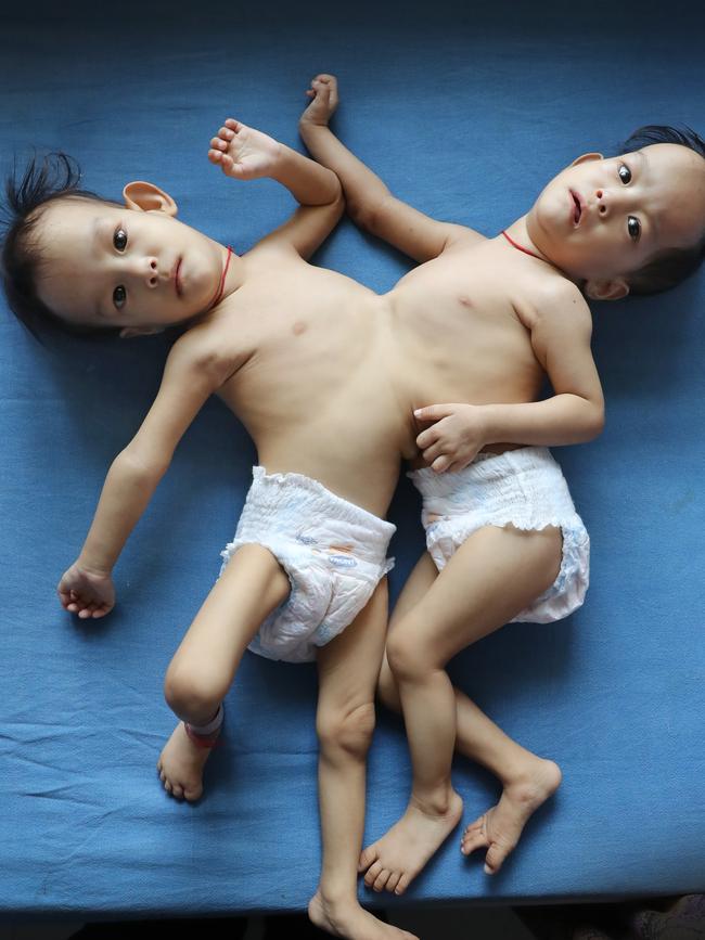 Pictured at 14 months, Nima and Dawa were flown to Australia to have life saving surgery, thanks to The Children First Foundation, and the Royal Children's Hospital. Picture: Alex Coppel