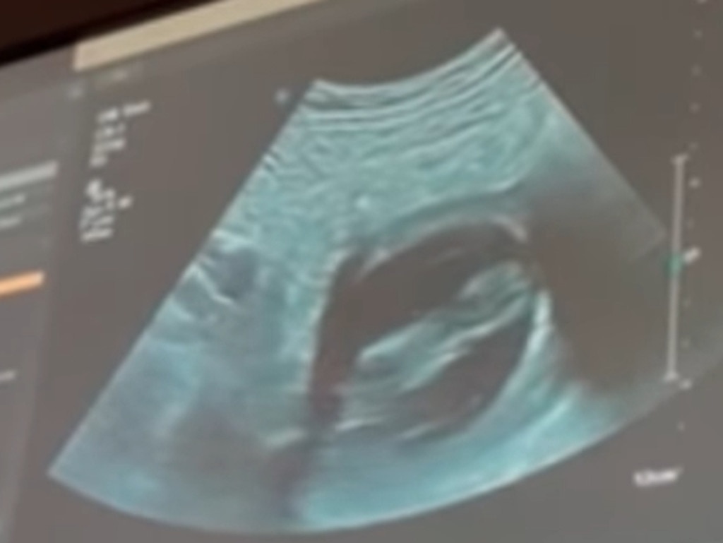 The ultrasound showing the girls’ pregnancy. Picture: Instagram