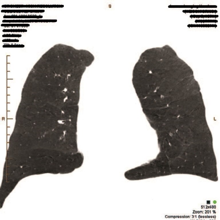 A scan of former Central Queensland miner Craig Keogh's lungs.