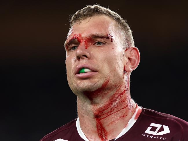 SYDNEY, AUSTRALIA - AUGUST 30:  Tom Trbojevic of the Sea Eagles is assisted by a trainer after an injury and a head cut during the round 26 NRL match between Canterbury Bulldogs and Manly Sea Eagles at Accor Stadium on August 30, 2024, in Sydney, Australia. (Photo by Cameron Spencer/Getty Images)