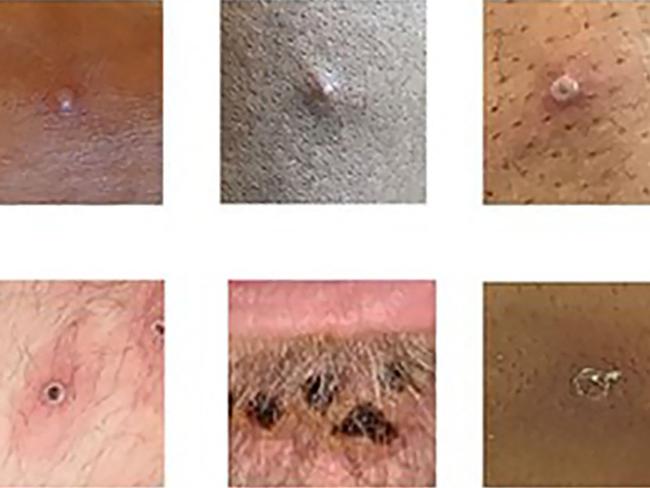 A handout picture made available by the UK Health Security Agency shows a collage of monkeypox rash lesions. In NSW, cases are presenting more often as pimples than lesions.