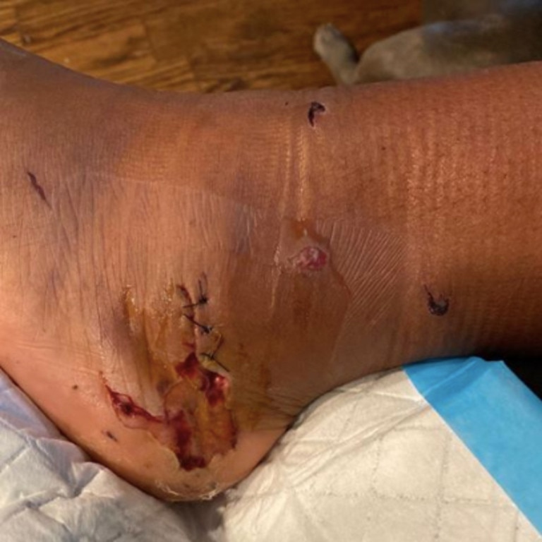 Megan Thee Stallion posted pictures of her wounds on Instagram but has since deleted the post.