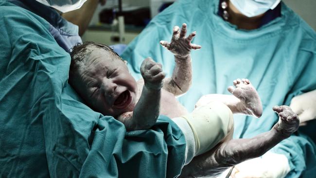 A controversial study that links Caesarean births to autism and ADHD has sparked a warning from Australian experts.