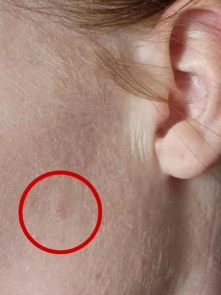 What she thought was a pimple turned out to be skin cancer. Picture: Facebook.