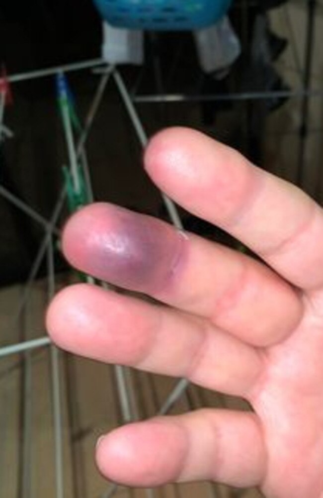 Shane Wyrzynski’s broken finger from an attack from a 14-year-old while he was working as a security officer in Surfers Paradise. Picture: Supplied