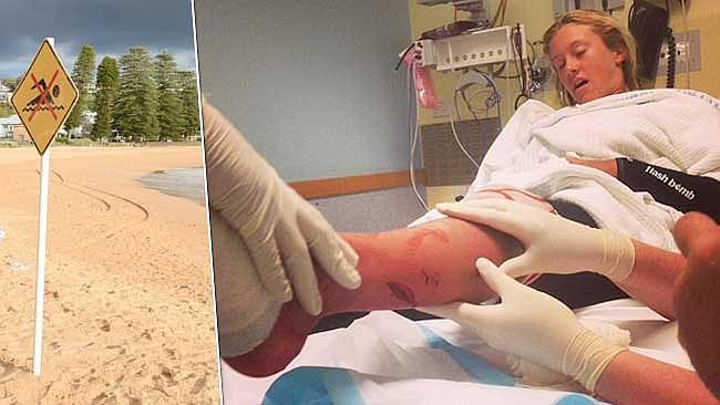 Shark attack surfer shares pics of bite