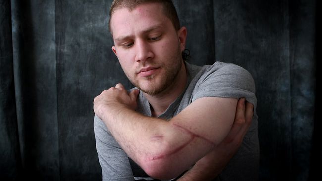Ahmad Chokr, former Bubble nightclub bouncer, shows his scars earlier this year. Picture: David Caird