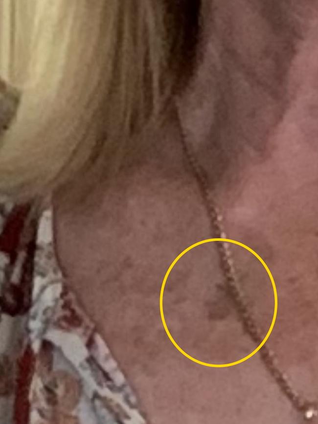 The blemish on Jillian’s chest that Leigh thought was suspicious. Picture: Kennedy News and Media