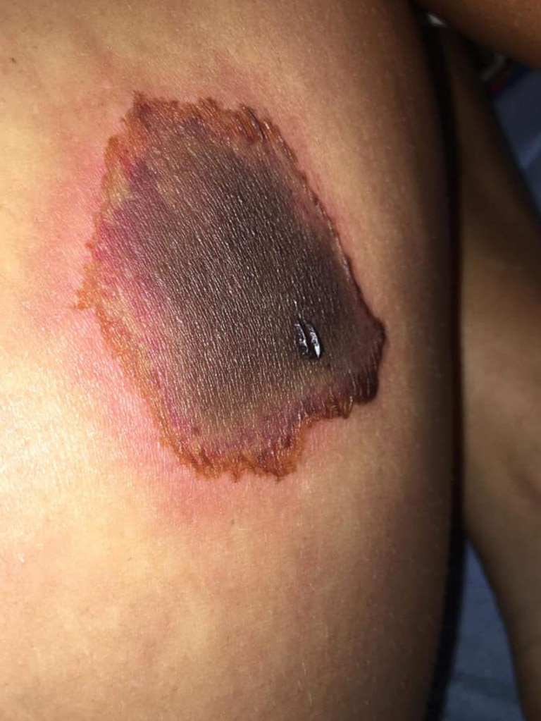 Horrifying photos reveal spider bite victim's 12-month ordeal