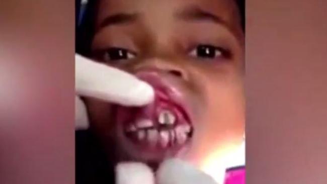 Video shows 15 maggots being removed from schoolgirl's gums