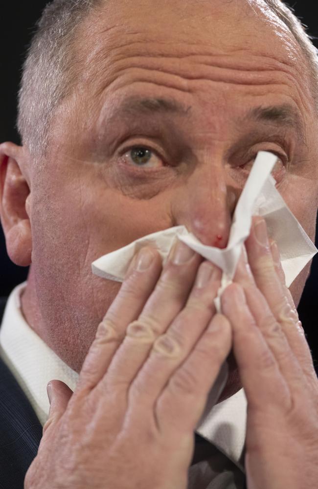 Politics really is a blood sport for Nationals leader and Deputy Prime Minister Barnaby Joyce who had to deal with a nose bleed while he addressed the National Press Club in Canberra. Picture: NCA Newswire/ Andrew Taylor