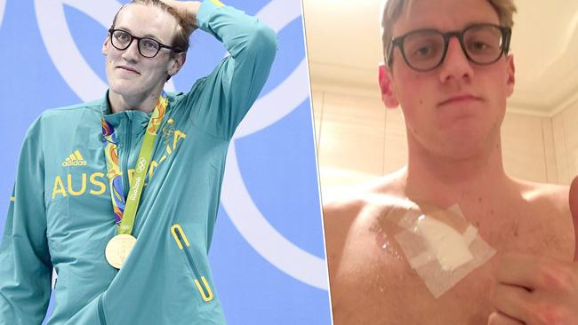 Mack Horton with his gold medal in Rio and after having a suspicious mole cut from his chest.