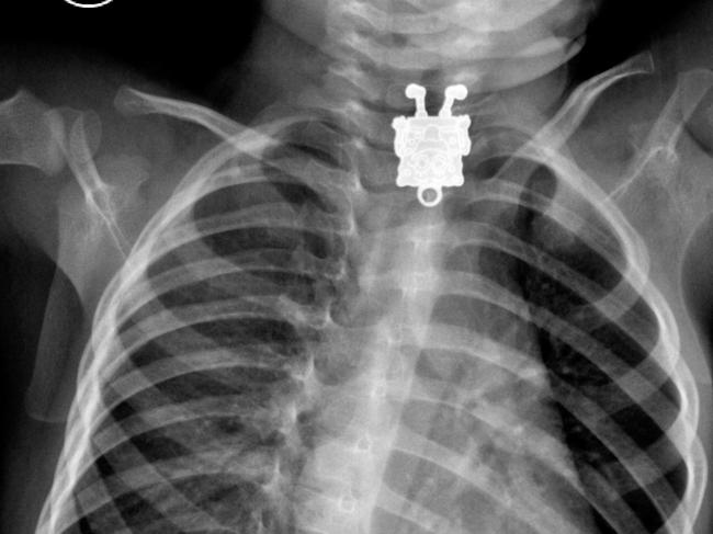 X-rays show weird things people put in their body