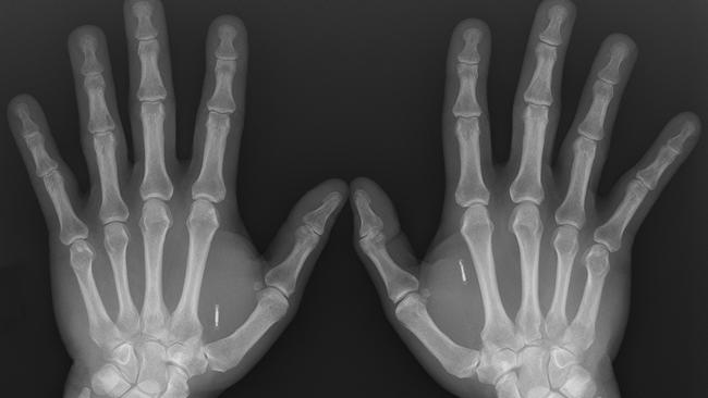 Implant Technology: I’ve Got You, And Lots Of Data, Under My Skin | The ...