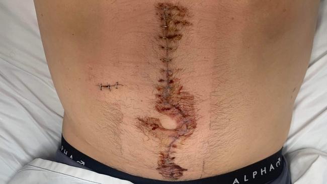 Ryan Duck's abdomen after surgery following the knife attack at Pacific Palms on November 27, 2022. Picture: Supplied.