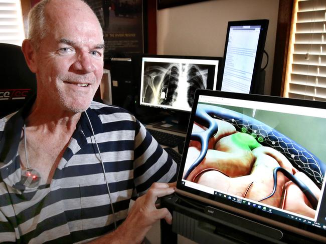 World first Medical breakthrough - Melbourne scientists and surgeons have placed electronic implants into the brains of disabled patients so the can control devices with their thoughts. MND sufferer Phil O'Keefe, 60, is the second person to undergo the implant and is now able to use his thoughts to work a computer. Phil looks at an image of the implanted electrode that sits in the vein of his brain and is connected via his chest.    Picture: David Caird