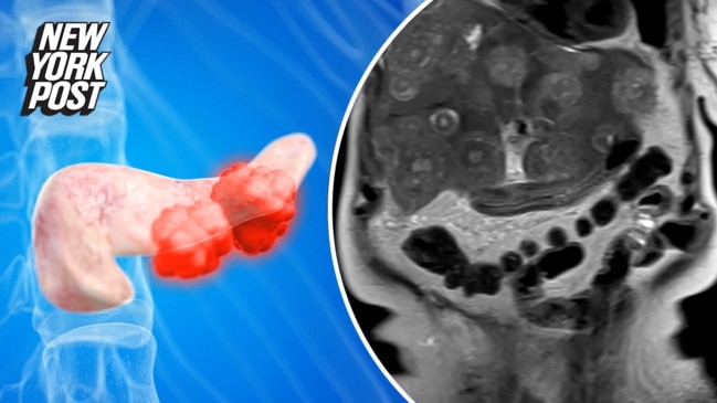 Pancreatic Cancer Rates ‘rising Rapidly’ Among Younger Women | News.com ...