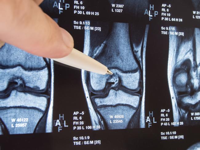 Knee joint x-ray or MRI. Doctor pointed on area of knee joint, where pathology or problem is detected, such fracture, destruction of joint, osteoarthritis. Diagnosis of knee diseases by radiology.  Picture: istock