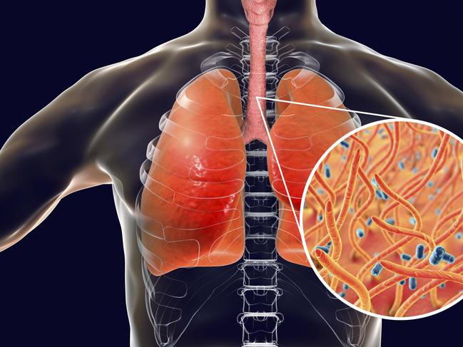 Whooping cough, conceptual illustration. Whooping cough is a highly contagious infectious disease caused by Bordetella pertussis bacteria. The main symptoms are paroxysms of cough and inspiratory whoop. B. pertussis are gram-negative, aerobic, non-motile, coccobacillus bacteria. They are spread by coughing and by nasal drops. The incubation period is 7-14 days. B. pertussis bacteria initially locate in nasopharynx where they multiply and produce number of toxins including tracheal cytotoxin (TCT). TCT causes extensive damage to ciliated epithelial cells of trachea and contributes to the cough characteristic of pertussis. Treatment is with antibiotics. A vaccine is available for this bacterial pathogen. Pertussis vaccine is part of the DTaP (diphtheria, tetanus, acellular pertussis) immunization.