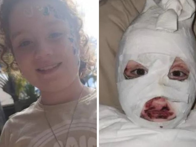 8yo suffers horrific burns. Picture: GoFundMe