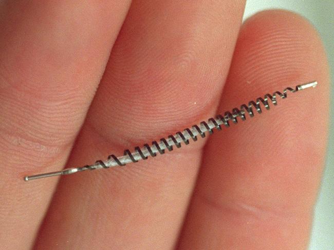 Birth control procedure Essure PBC where a small metal coil is used to block the fallopian tubes 15 Jun 2001.  microcoil