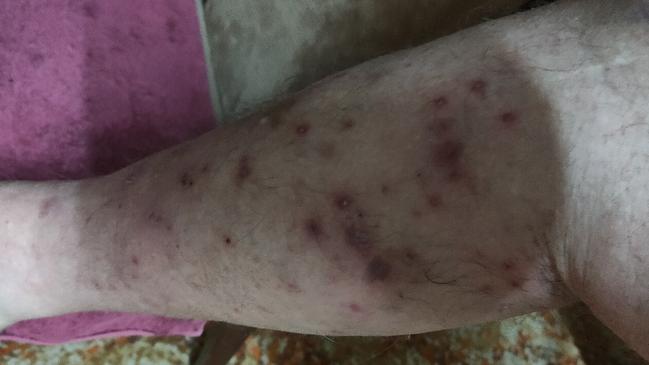 Peter Strawbridge caught scabies from his wife and is not allowed to visit her until he recovers. This image appears to show an infestation on his leg. Picture: Supplied