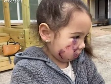 Girl, 3, cheek torn open by pit bull