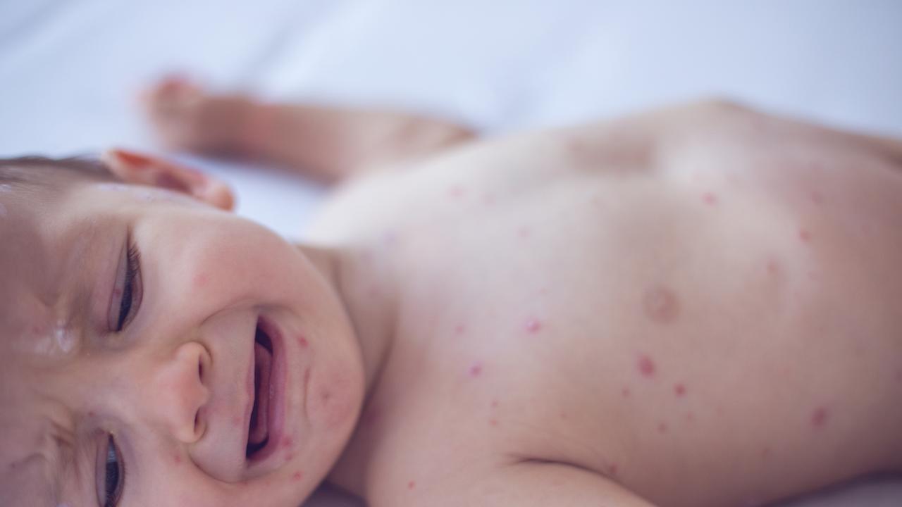 SA Health measles alert: Exposure sites listed after baby infected ...