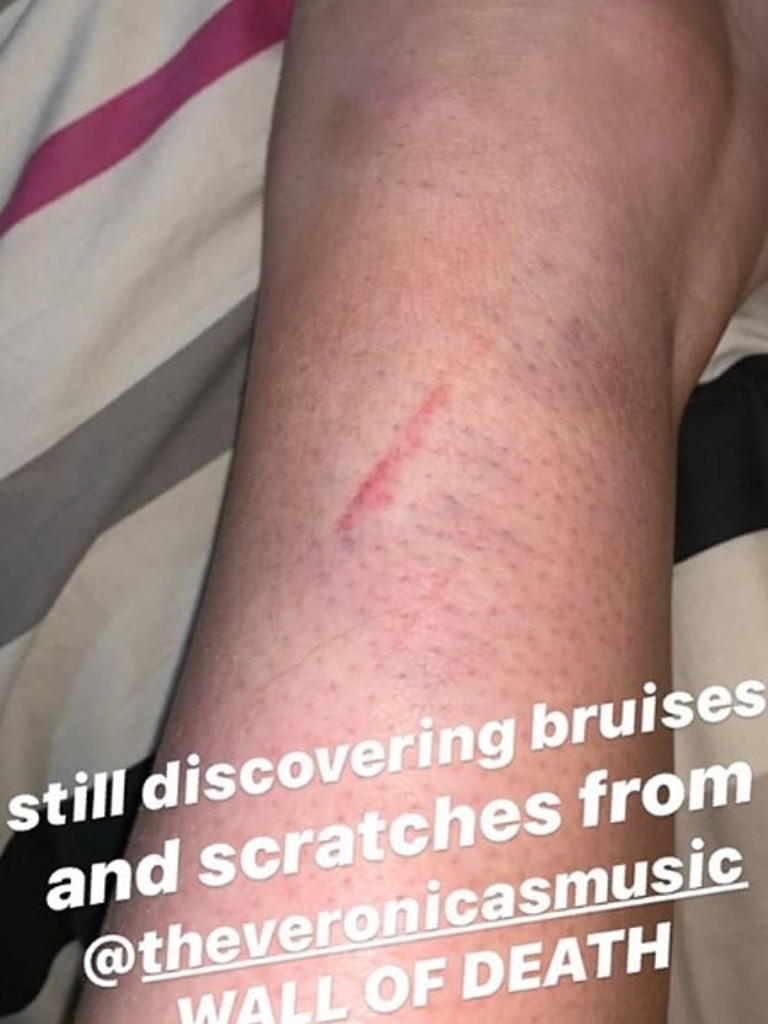 Fans have shared pictures of their ‘injuries’. Picture: Instagram