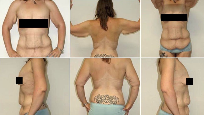 100kg weight loss, excess skin removal: 'I felt like a melted candle