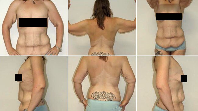 Tracey Searle lost 100kg in 18 months and had three surgeries to remove her excess skin.