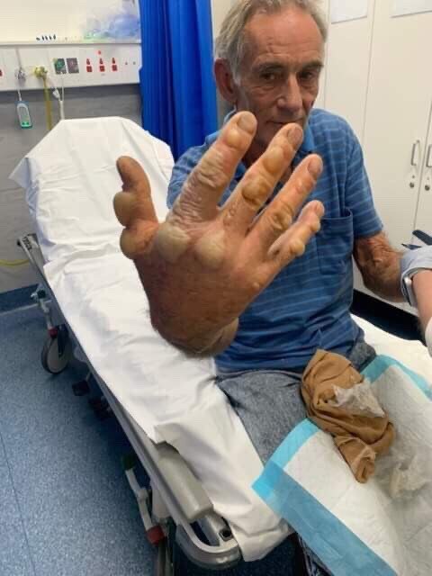 Dennis Gilbert sustained severe burns to his hand and was taken to hospital in Bairnsdale. Picture: Supplied