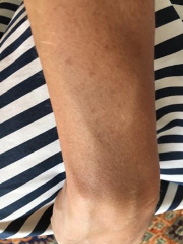 The picture showing bruising on Ms Landry’s arm.