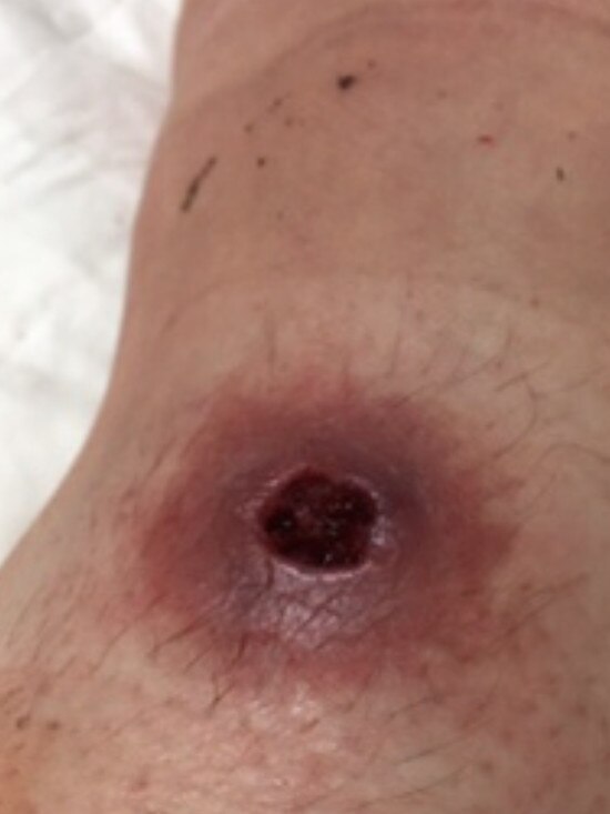 A nasty case in Frankston of the Buruli ulcer.