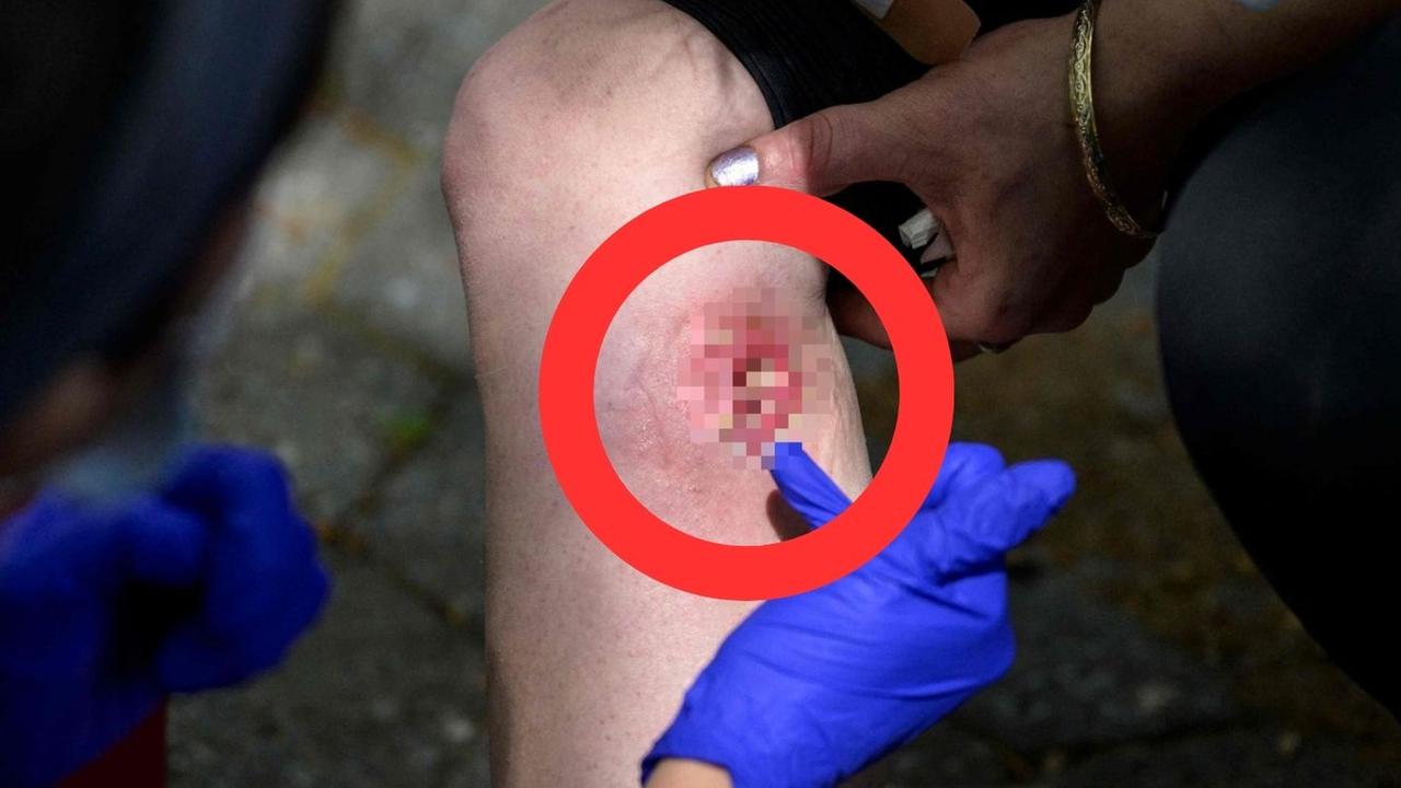 A new drug doing the rounds in the US is leaving severe wounds. Picture: AFP