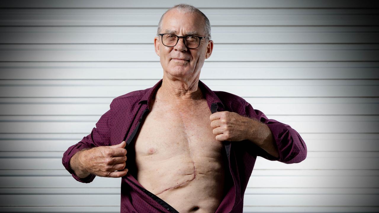 Barrie Tibbetts shows his scar. Picture: Richard Walker