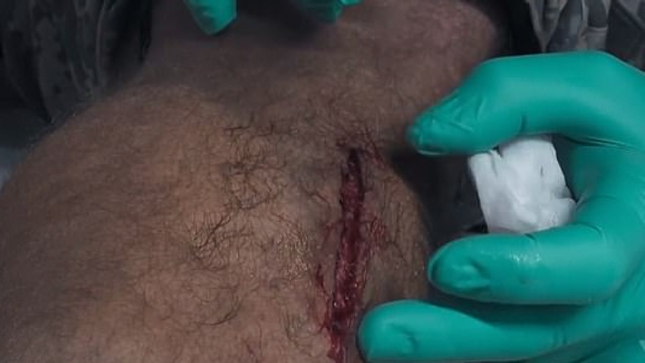 Nick Cummins attained a huge cut which needed stitches.