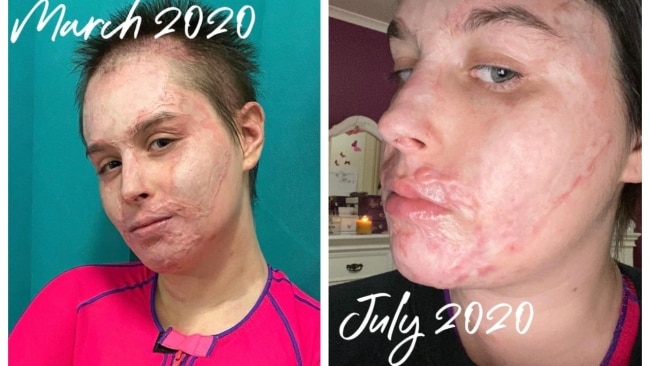 White Island survivor Stephanie Browitt has shared a series of images with her Instagram followers showing her recovery. Picture: Instagram