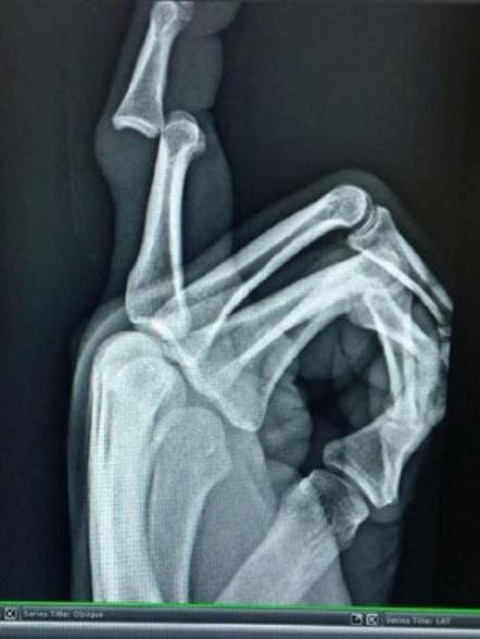 Trent Merrin's finger injury.