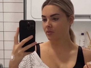 NZ model removes implants after crippling pain