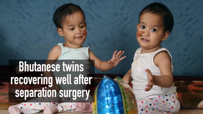 Bhutanese twins recovering well after separation surgery