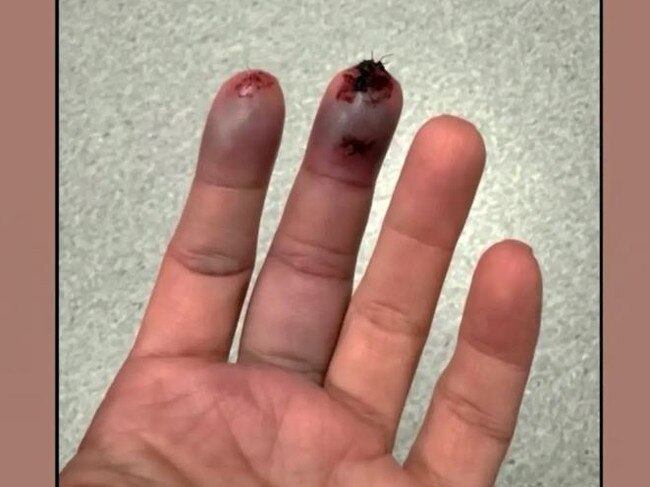 A sliding door slammed on Kim’s fingers.