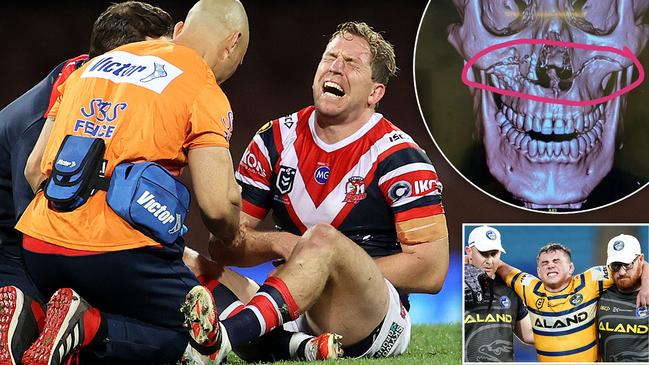 NRL injuries are up significantly in 2020.