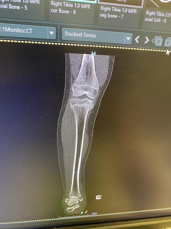 A chunk of her tibia came off in the break.