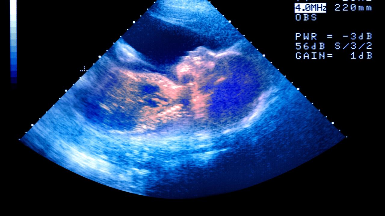 2000-ivf-rebate-for-nsw-families-the-australian